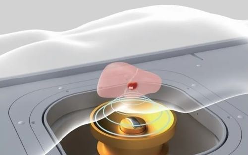 关爱健康，无创守护 | 苏州名仕医院“高强度超声聚焦无创治疗"筛查活动开启(图3)